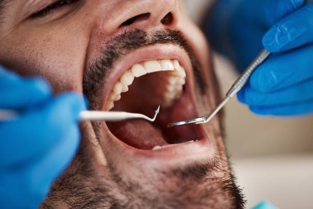 Best Emergency Tooth Extraction in James Island, SC